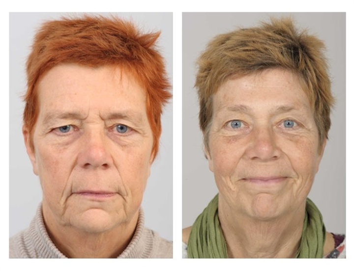 Correctie van de bovenoogleden en lift van de wenkbrauwen