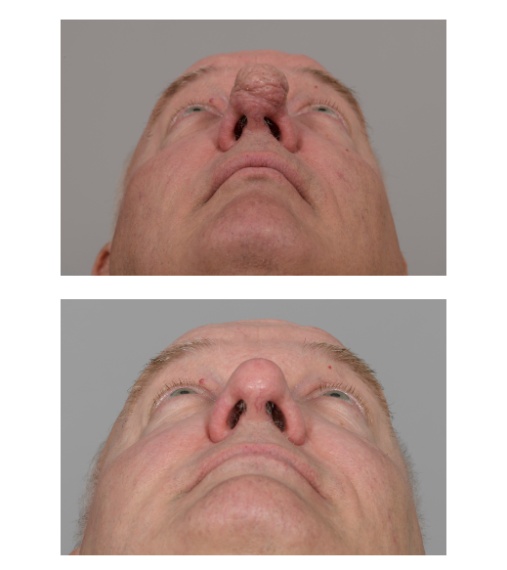 Talgklier-woekering (rhinophyma) van de neuspunt.
