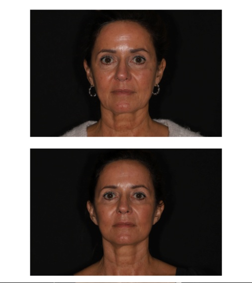 Volume verplaatsing en contour verbetering geeft je een frisser uiterlijk zonder te veranderen