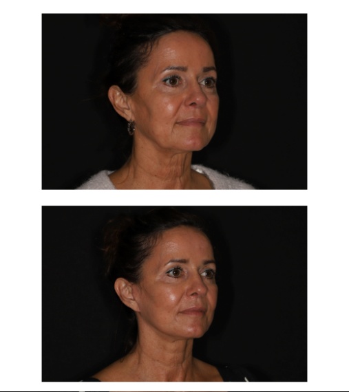 Bij de facelift gaat het om volume verplaatsing en contour verbetering