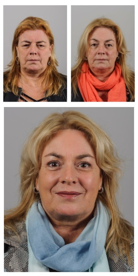 Facelift