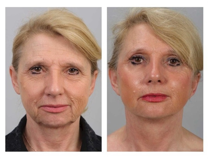 Facelift in 2013
(zie ook de foto's van de behandeling in 2023).