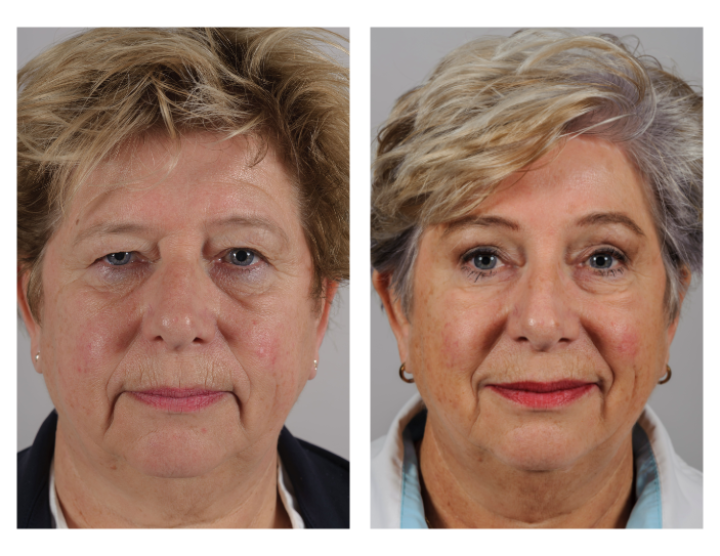 Facelift