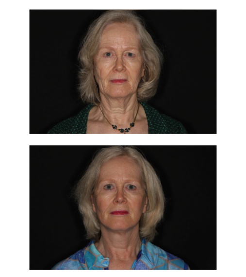 Facelift / halslift