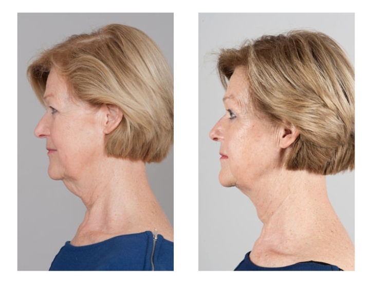 De beperkte halslift middels een platysma plastiek