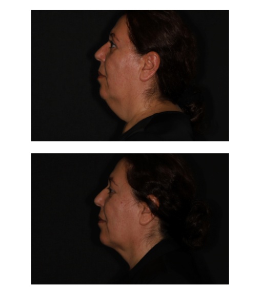 Halscorrectie middels (oppervlakkige) liposculptuur