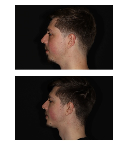 Kincorrectie met een implantaat, waarbij de hals(hoek) zonder liposuctie ook duidelijk verbetert