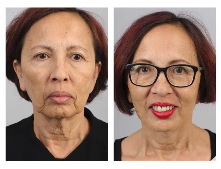 Facelift
