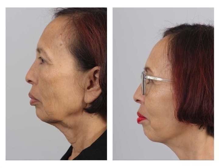 Het positieve effect van de facelift op de hals
