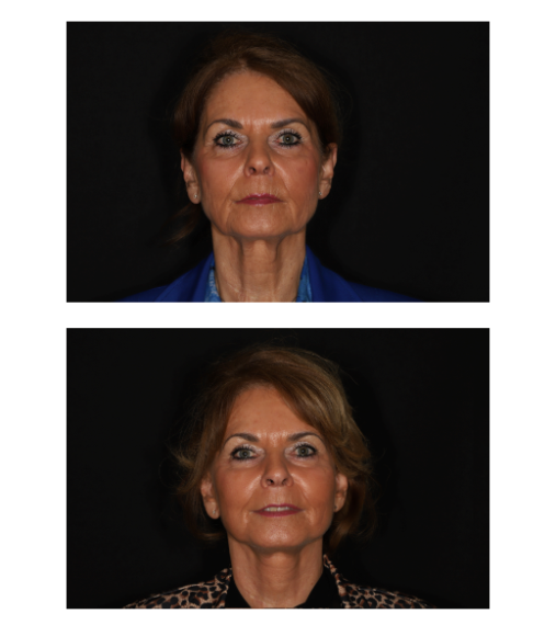 Facelift