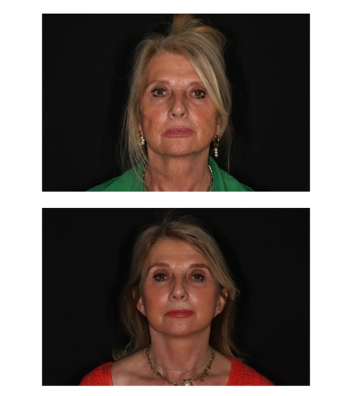 Facelift (2023) in combinatie met lipofilling ter verbetering van de textuur van de huid