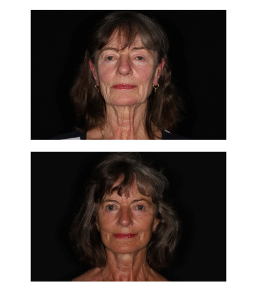 Facelift / halslift