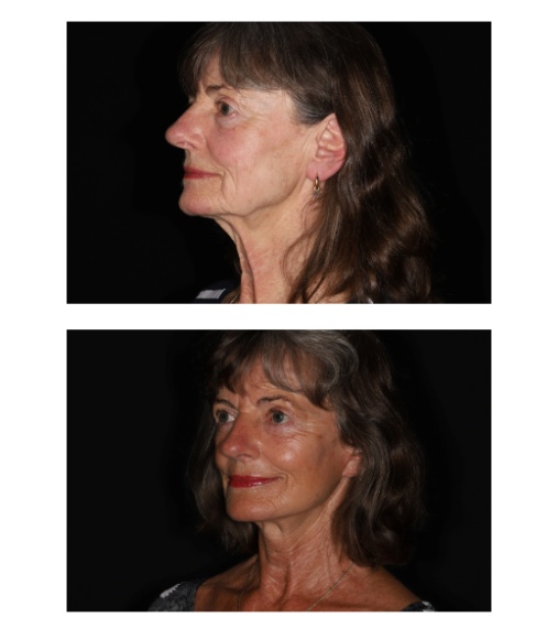 Facelift / halslift