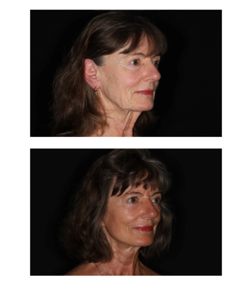Facelift / halslift